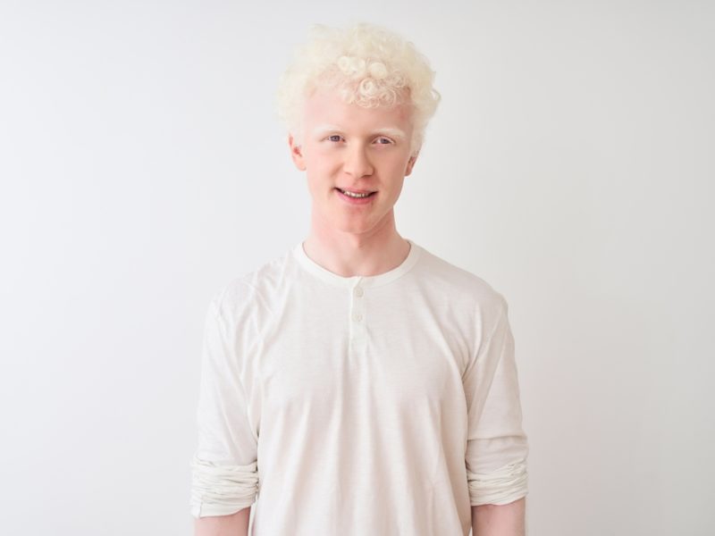 Albinismo: entenda a condição e como espalhar a conscientização